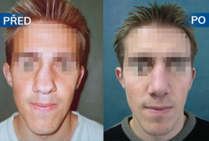 Pacient před a po plastické operaci nosu (rinoseptoplastika)