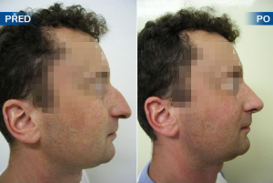 Pacient před a po plastické operaci nosu (rinoseptoplastika)