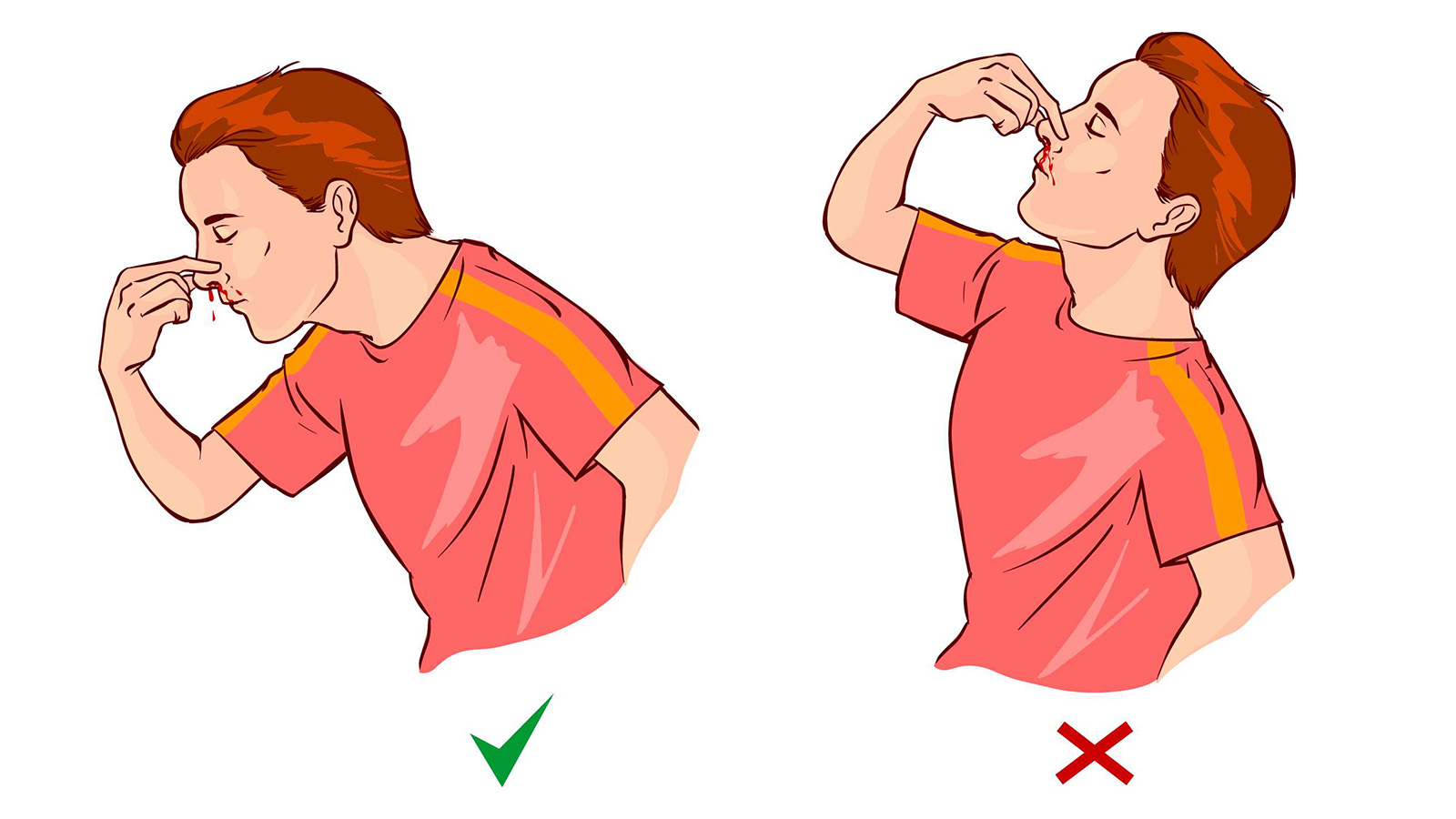 Co dělat při krvácení z nosu (epistaxe)